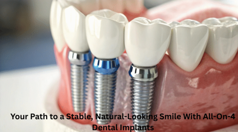 Your Path to a Stable, Natural-Looking Smile With All-On-4 Dental Implants